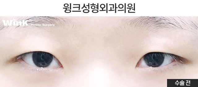 인라인 자연유착 쌍꺼풀 수술에 대해 알아볼까요? 관련 이미지 2