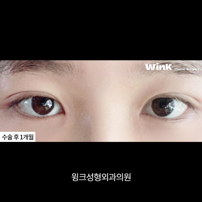 Double-Eyelid Stitching, WINK Plastic Surgery Natural Adhesion image 5