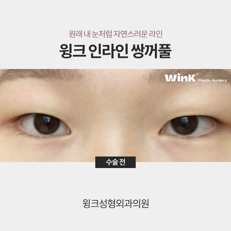 A Natural Line That Looks Just Like Your Original Eyes: In-line Double Eyelids image 7