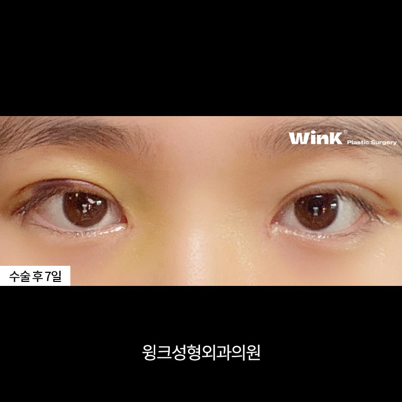 Double-Eyelid Stitching, WINK Plastic Surgery Natural Adhesion image 4