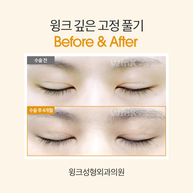 How Do You Release Deep Double Eyelid Fixation? image 4
