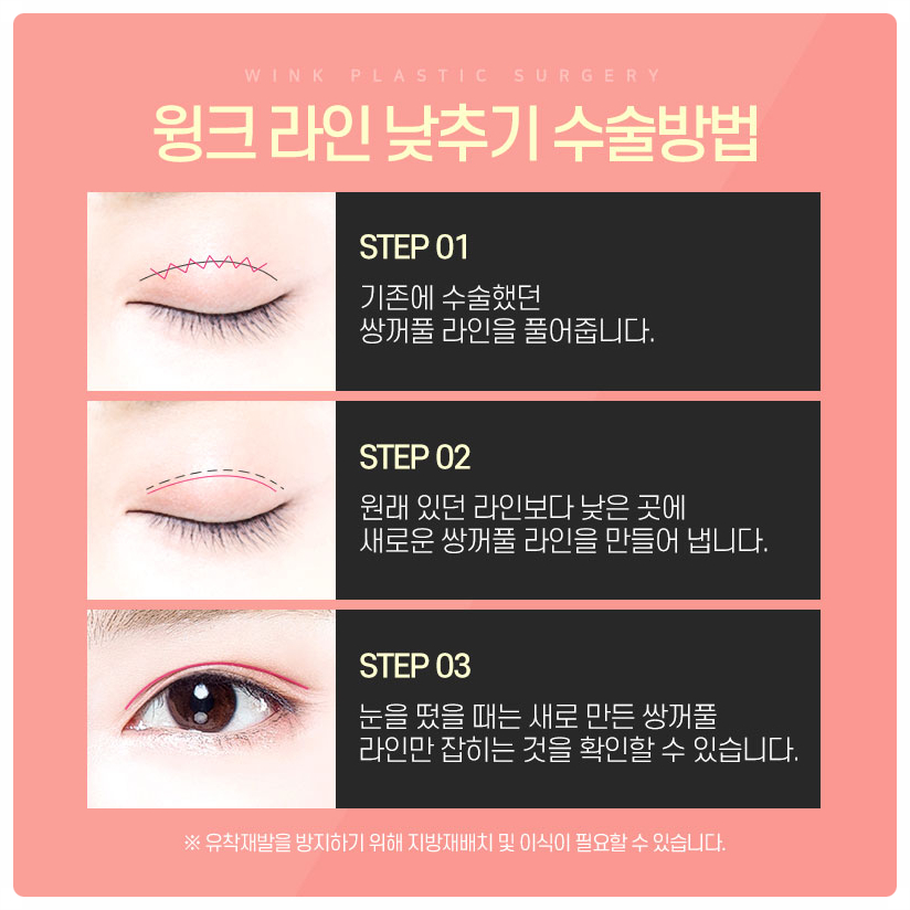 소세지눈재수술 서울눈재수술 눈재수술병원 알아본다면 윙크성형외과 관련 이미지 3