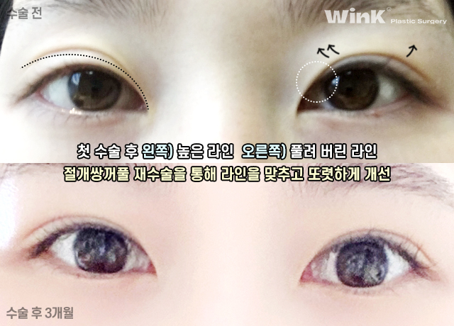 꼬막눈 쌍수도 시원하게! 눈성형 중점 진료 윙크성형외과 관련 이미지 7