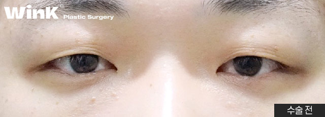 Monolid, inner double eyelid, or outer double eyelid? Choose the line that suits you! Men’s eye surgery at Wink Plastic Surgery image 2
