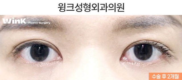 Case Examples of Correcting Uneven Eyes Through Ptosis Correction image 8