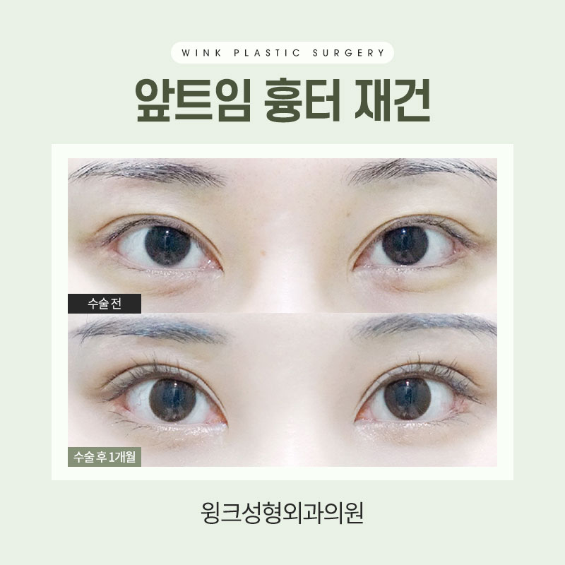 앞트임 흉 재건에 대해 알아보겠습니다. 관련 이미지 3