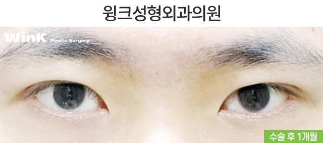 남자 속쌍꺼풀 눈매교정에 대해 알아볼까요? 관련 이미지 3