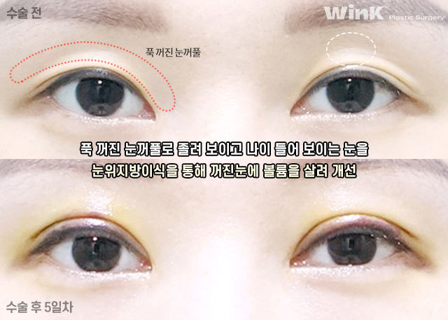 What Kind of Double Eyelids Suit Deep-Set Eyes? image 7