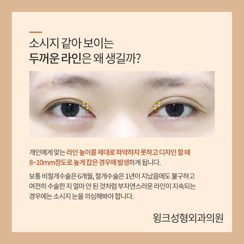 앞쪽이 두꺼운 아웃라인 쌍꺼풀, 해결 방법은? 관련 이미지 2