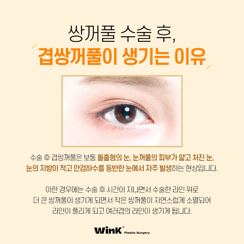 Double Eyelid Surgery Left You with a Double Fold? Fix It Neatly with Revision Surgery for Double Folds at Wink Plastic Surgery! image 2