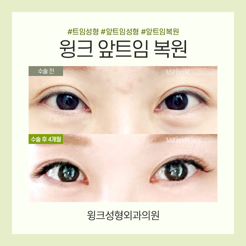 트임복원) 과도하게 트인 앞트임부작용을 앞트임복원으로 깔끔하고 자연스러운 결과 관련 이미지 6