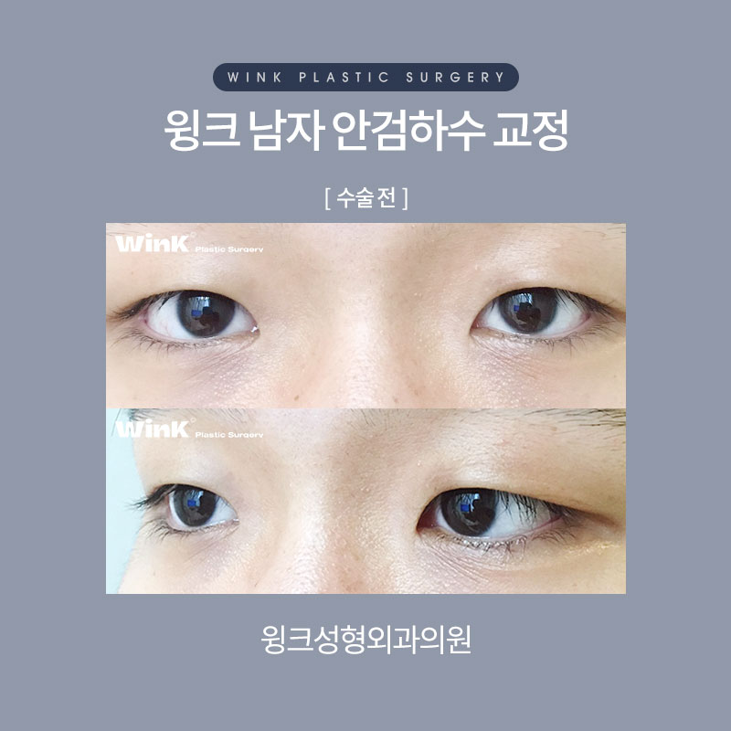 남자안검하수 또렷하게 교정하여 시원한 인상으로 개선하는 방법 관련 이미지 4