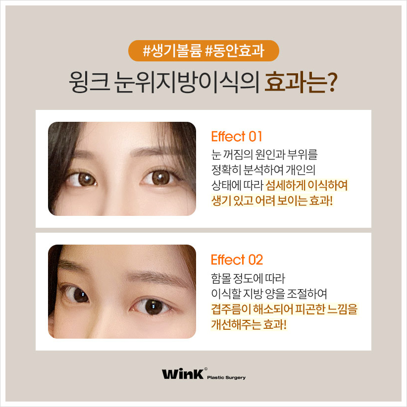 If You're Curious About Upper Eyelid Fat Grafting Reviews: Wink Plastic Surgery, Sinsa Upper Eyelid Fat Grafting Price, and Before-and-After for Hollow Eyes image 6