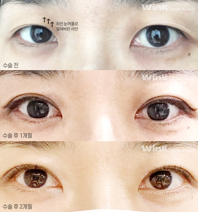 About Upper Eyelid Surgery for Middle-Aged Patients image 4