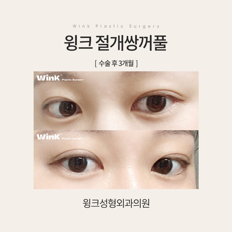 Let’s Learn About Incisional Double Eyelid Surgery image 4