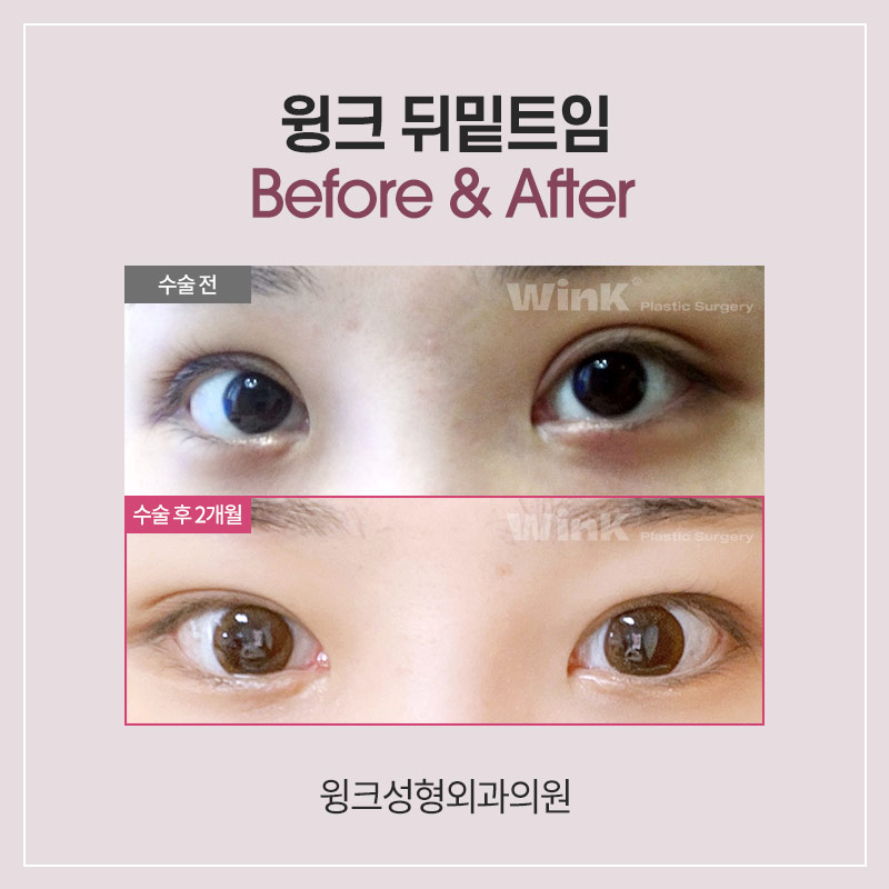 Shall We Learn About Canthoplasty and Dual Canthoplasty? image 6