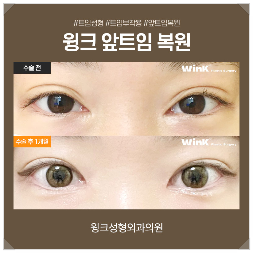 Recovery Period After Epicanthoplasty Restoration, Epicanthoplasty Scar, If You’re Only Looking Into Epicanthoplasty, Wink Plastic Surgery image 4