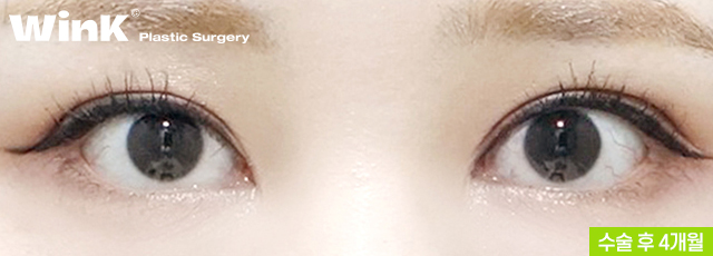 Thick Double Eyelids, “Sausage Eyes.” Let’s Improve Them Naturally with Wink’s Double-Incision Double Eyelid Revision Surgery! image 4