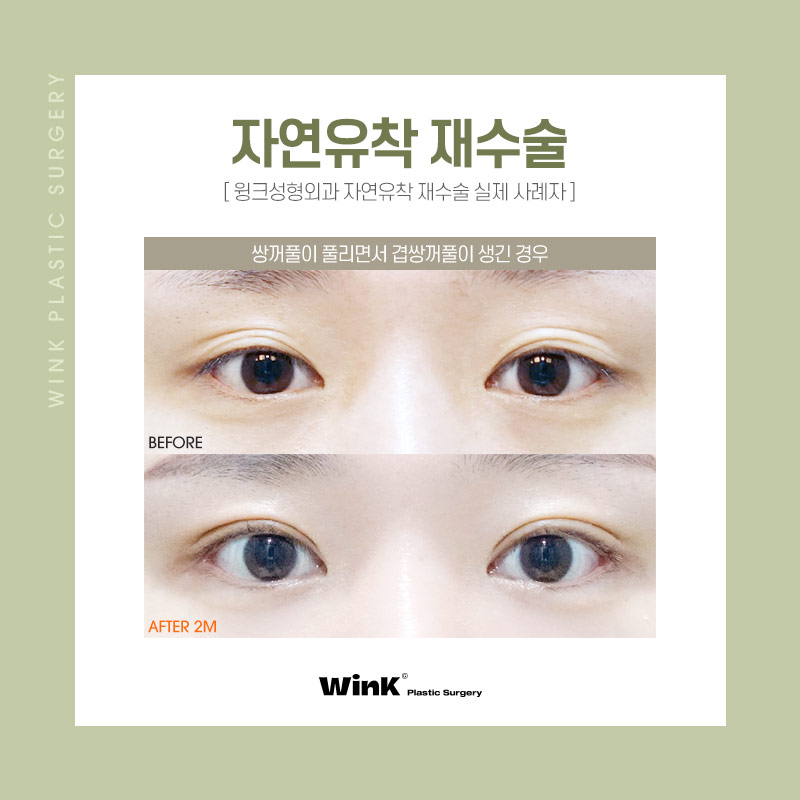 Natural and Clear Fixation for a Natural Adhesion Revision Surgery at Wink Plastic Surgery with No More Failures image 4
