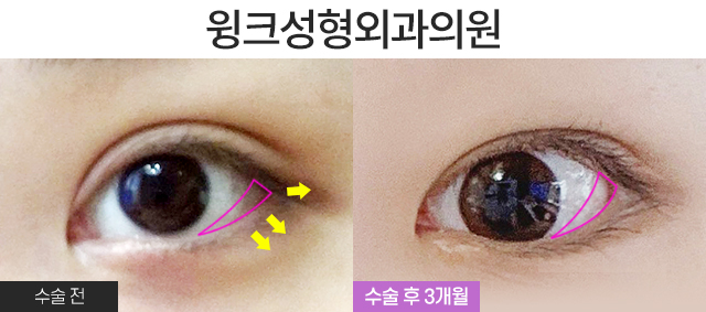 Make a Fierce Eye Shape Look Gentle with Outer and Lower Corner Eye Surgery! image 4