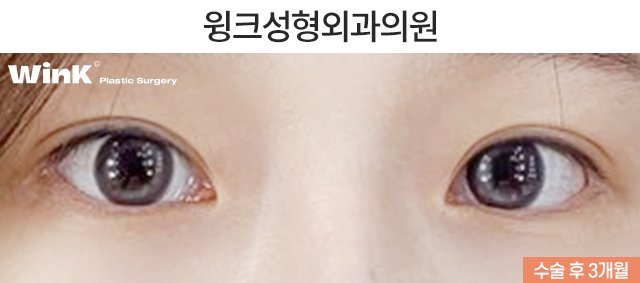 자연유착 재수술 시 주의점에 대해 알아보겠습니다. 관련 이미지 6