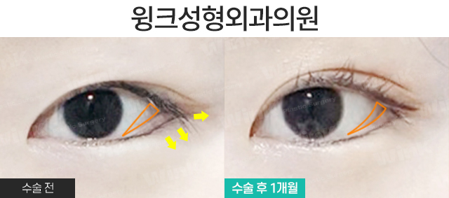 뒷밑트임으로 눈의 숨겨진 공간을 찾자! 윙크 듀얼트임 관련 이미지 4