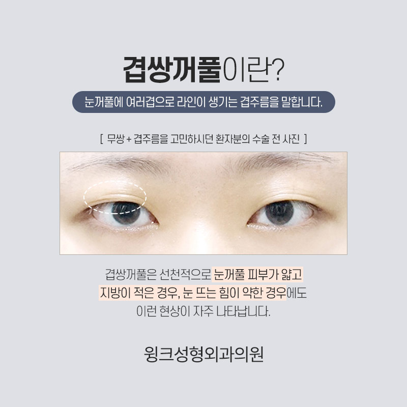 자연유착 쌍꺼풀수술로 겹주름을 해결하려면? 관련 이미지 3