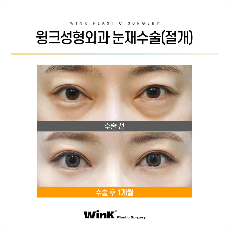 절개쌍꺼풀잘하는곳 눈수술후관리 윙크성형외과에서 눈성형 궁금증 풀어드려요 관련 이미지 5