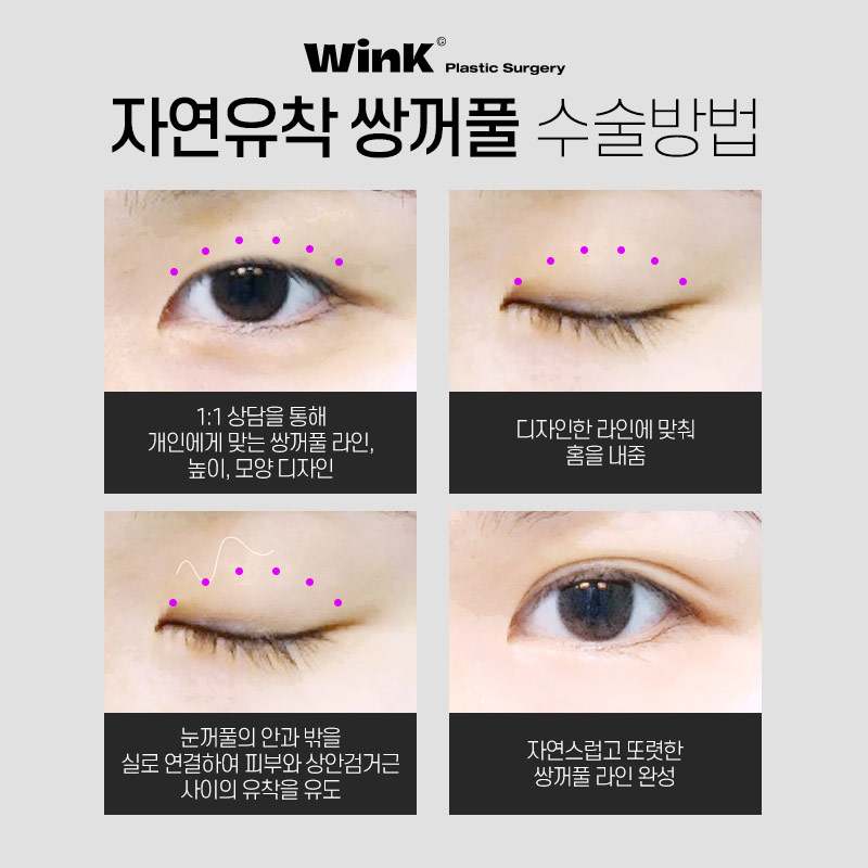 Natural Yet Secure Wink Plastic Surgery Natural Adhesion Double Eyelids image 3