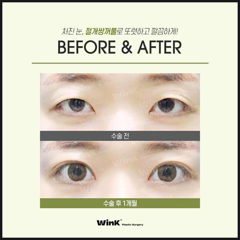 쌍수자연유착의 모든것 윙크에서 알려드려요 자연유착쌍꺼풀후기 쌍꺼풀수술잘하는곳 관련 이미지 5