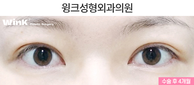 Shall We Learn About Revision Double Eyelid Surgery? image 3