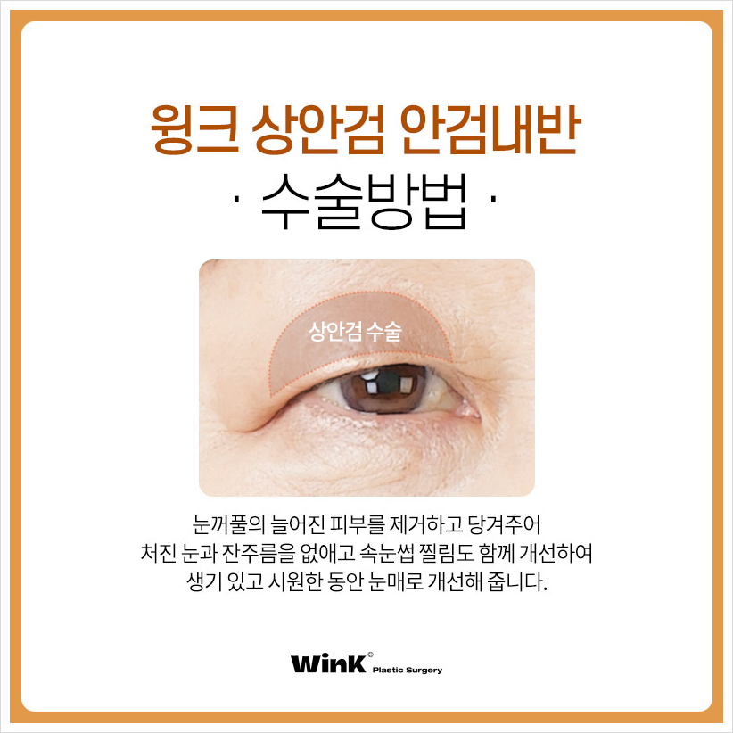 상안검안검내반 속눈썹찔림수술  윙크성형외과 안검내반수술후기 관련 이미지 5