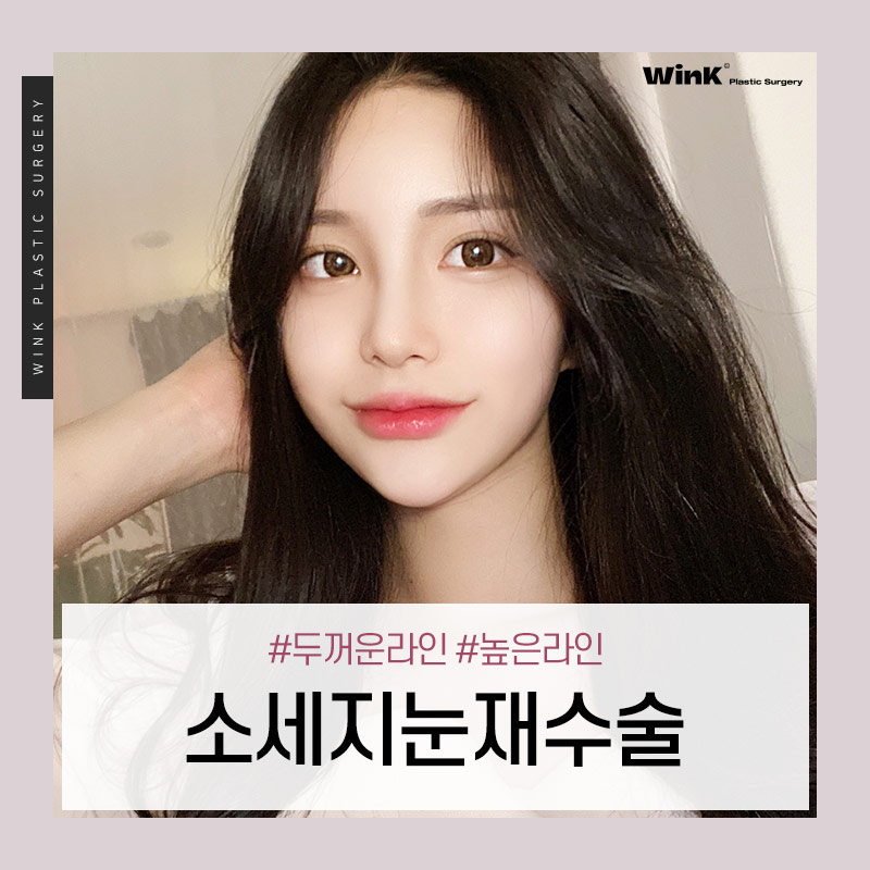 두껍고 높은 소세지눈? 윙크성형외과 두줄따기 눈재수술로 개선 관련 이미지 1