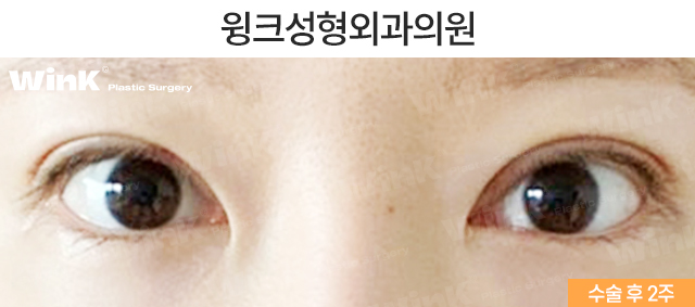 소세지눈 재수술, 두줄따기로 라인 낮추기 관련 이미지 3