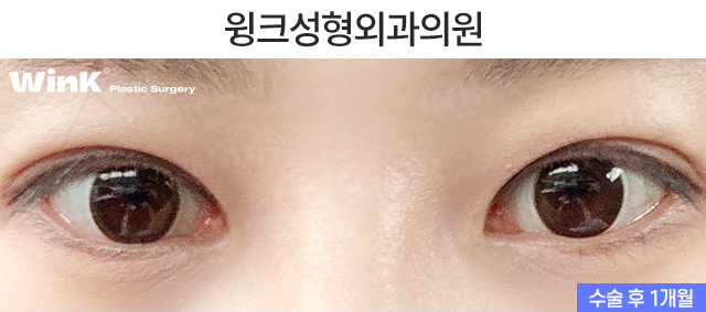 Let’s Learn About Double-Eyelid Revision Surgery with an Incision for a Thick Front Line image 4