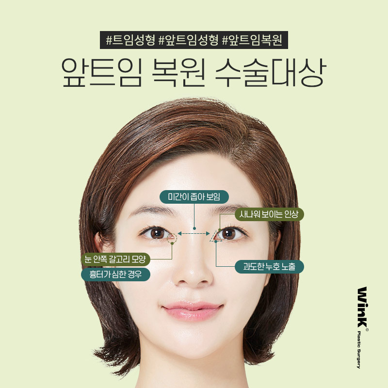 Wink Epicanthoplasty Restoration to Reclose Delicately Opened Inner Eye Corners! image 5