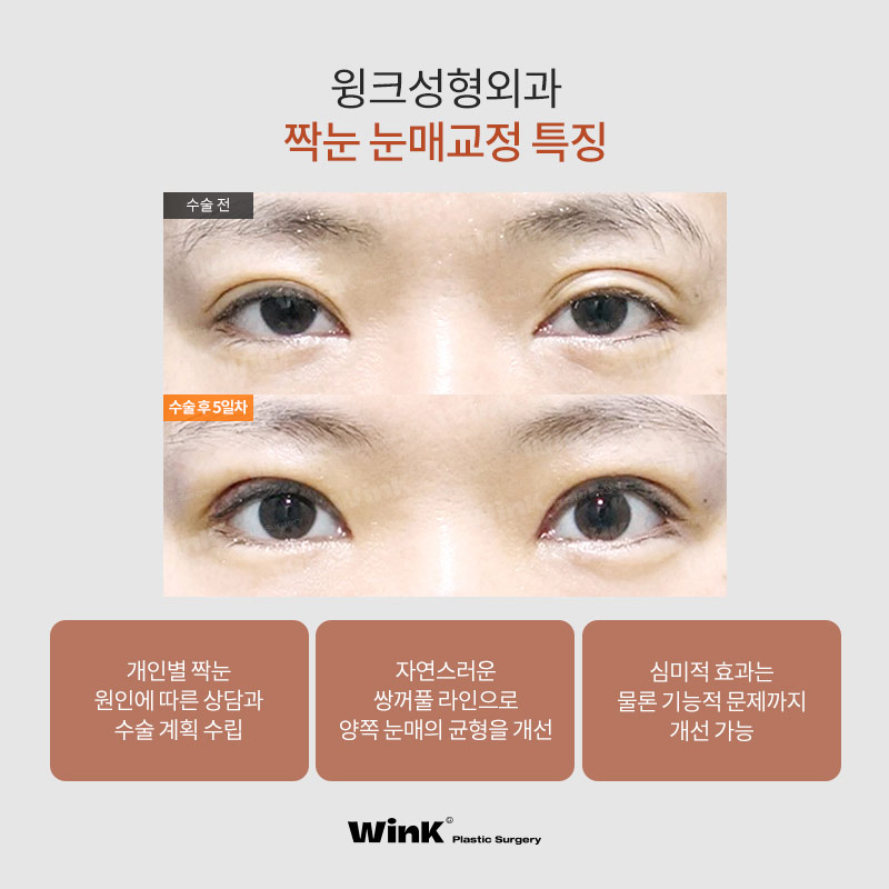 짝눈, 눈매교정으로 개선할 수 있을까? 윙크성형외과 눈매교정으로 가능해! 관련 이미지 7