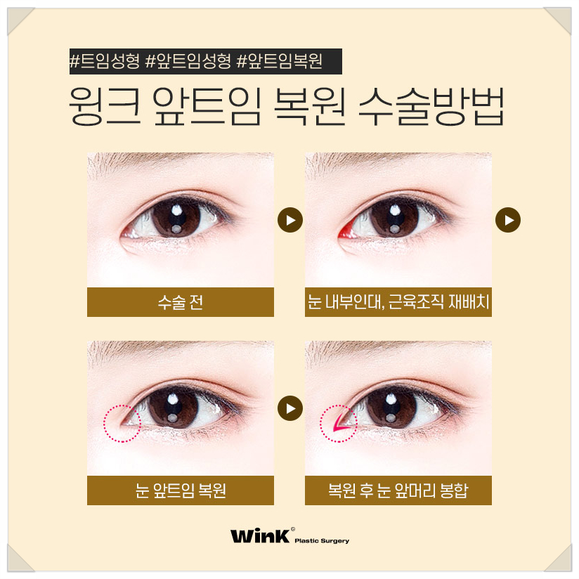 앞트임복원회복기간 앞트임복원후기 윙크성형외과 신사앞트임복원후기 앞트임부작용 관련 이미지 6
