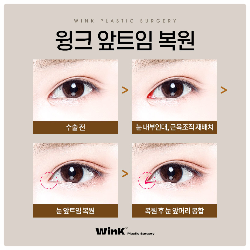 Epicanthoplasty Reconstruction: Recovery Period for Epicanthoplasty Restoration | Wink Plastic Surgery Epicanthoplasty Restoration Cost image 3