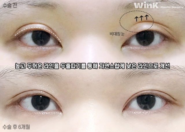 Shall We Learn About the Skin-Preserving Incision Method for Double-Line Reduction? image 4