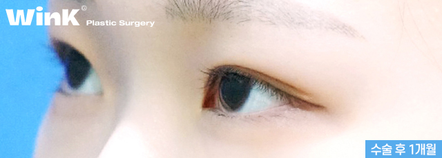 The Key to Ptosis Correction Is Proper Iris Exposure! image 3