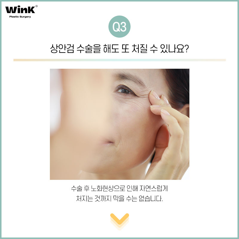 윙크성형외과에서 알려드리는 상안검에 대한 모든 것! 관련 이미지 6