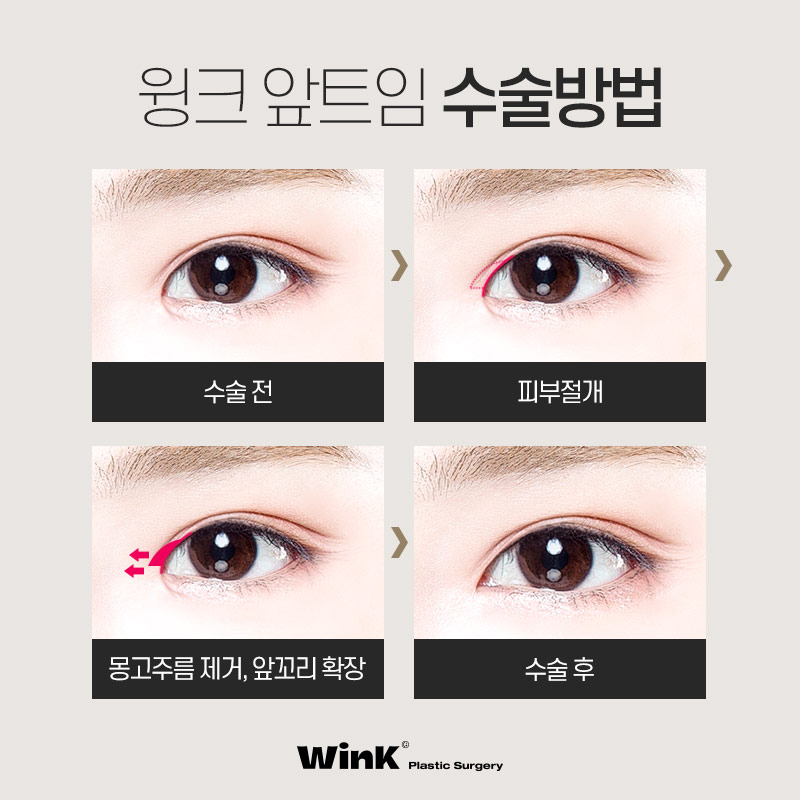 몽고주름이 쌍꺼풀 수술에 미치는 영향! 윙크성형외과에서 알려드려요 관련 이미지 6