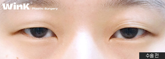 Non-incisional Eye Correction Review: A Natural, Clear Eye Shape! image 3