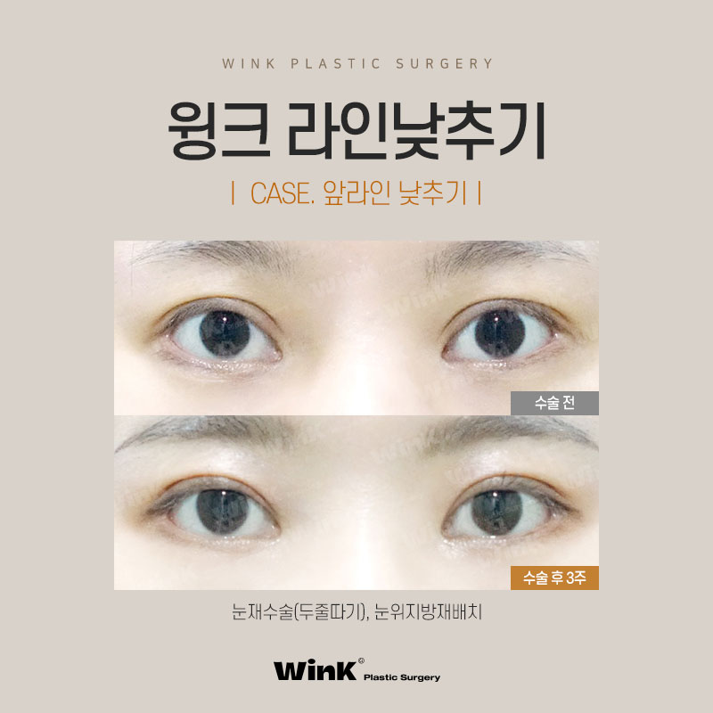 윙크성형외과 라인낮추기로 흉터 없이 원하는 쌍꺼풀 높이로! 관련 이미지 8