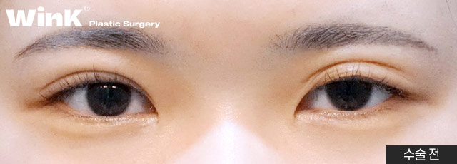 Wink Plastic Surgery Double Eyelid Revision Surgery, Pursuing Natural Results by Identifying the Exact Cause of Failure image 3