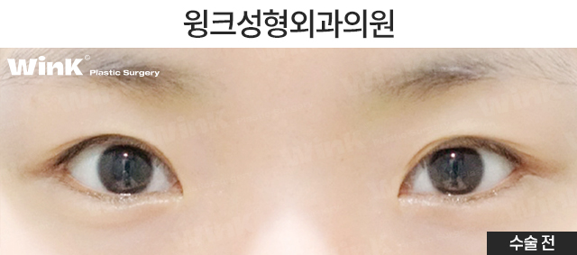 How Should Double Eyelid Surgery Be Performed for Small, Narrow Eyes? image 2