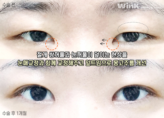 윙크성형외과는 절개쌍꺼풀 수술 후에도 빠르게 회복! 관련 이미지 5