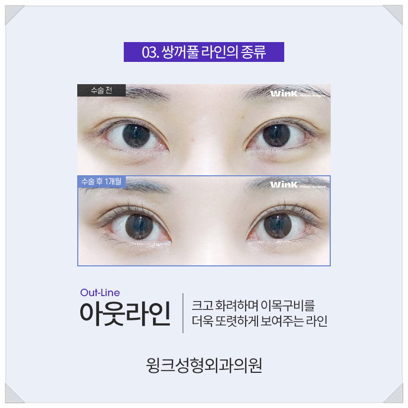 아이린눈 인아웃연예인?  윙크성형외과와 알아보는 쌍꺼풀라인종류! 관련 이미지 6