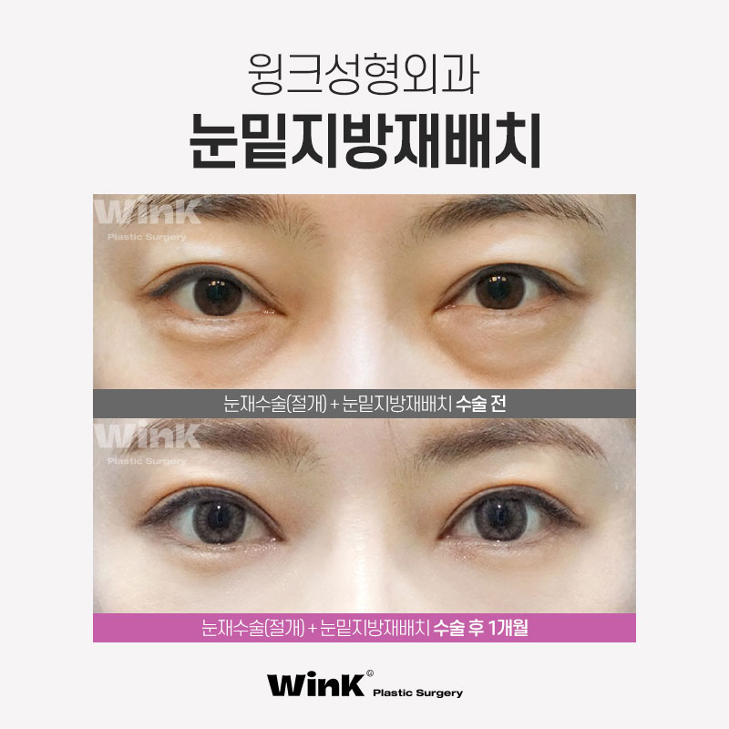 칙칙한 눈 밑, 생기 가득하게 윙크성형외과 눈밑지방재배치 관련 이미지 6